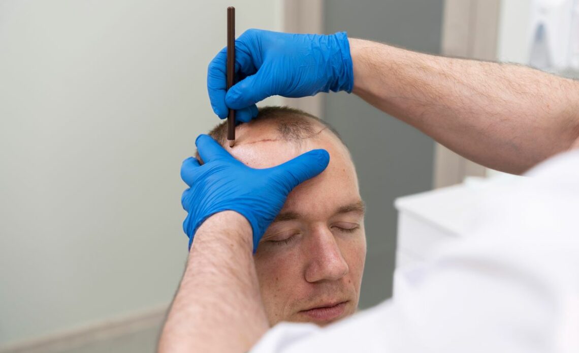 Hair Transplant Cost Comparison Guide 2024 Understanding Factors and